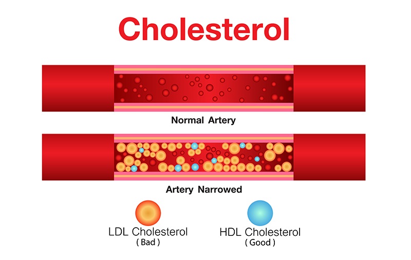холестерол в крови, фото